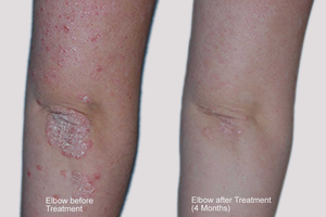 Dermahealer Psoriasis Elbow Treatment Results